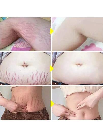 أفضل كريم طبيعي عضوي للتخلص من الندوب وإزالة السيلوليت والعلامات الناتجة عن الحمل لدى النساء