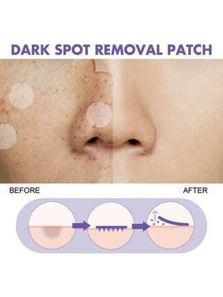 ملصقات إزالة البقع الداكنة للوجه - معالجة مُنِيرة تقلل من التصبغ والبقع العمرية والتصبغ الزائد، رعاية مرطبة للبشرة 144 قطعة/صندوق