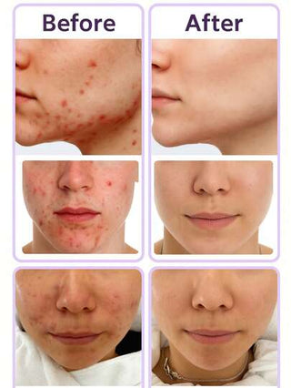 كريم حمض الأزيليك للوجه - كريم البشرة للروزاسيا لتقليل الحبوب والأكياس الدموية والتصبغات والاحمرار - جل حمض الأزيليك للعناية بالوجه والبشرة