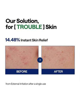 Mediheal سيروم هيدرا المهدئ بشجرة الشاي 40مل، صيغة خفيفة غير لزجة، مستخلص شجرة الشاي بتركيز 19,900 جزء في المليون للتهدئة الفورية، حمض الهيالورونيك بتركيز 2,800 جزء في المليون للترطيب العميق، مناسب للبشرة الحساسة والدهنية.